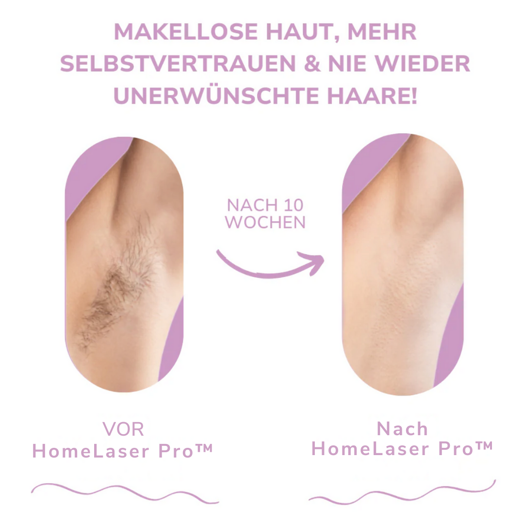 HomeLaser Pro™ – Schmerzfreie Haarentfernung für zuhause.